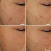 Oriflame Novage+ Blemish Plus Age Defy Routine Light 5 Piece Skincare Set